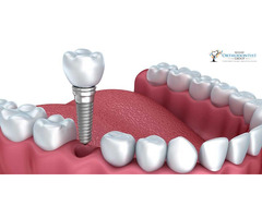 Dental Implants | Miami Orthodontists Group