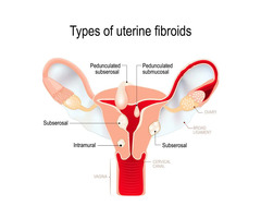 Empowering Wellness: Understanding the Benefits of Uterine Fibroid Embolization Procedure for Fibroi