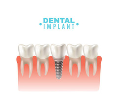 Your Guide to a Strong and Stunning Dental Implant Abutment