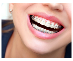 Transform Your Smile with Leading Orthodontics and Invisalign Treatment in Overland Park