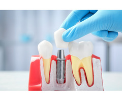 Transform Your Smile with Expert Dental Implants in Dunwoody
