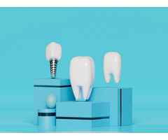 Professional Dental Implants - Elevate Your Practice with Expertise